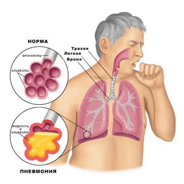 Пневмония у взрослых: симптомы, причины и лечение